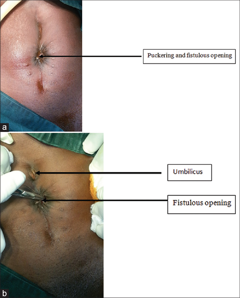 Figure 1: (a) The fistulous opening in the abdominal incision scar, (b) the fistulous opening in the abdominal incision scar