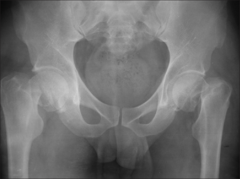 Figure 1: Preoperative pelvic X-ray showing Stage IV bilateral femoral neck fractures
