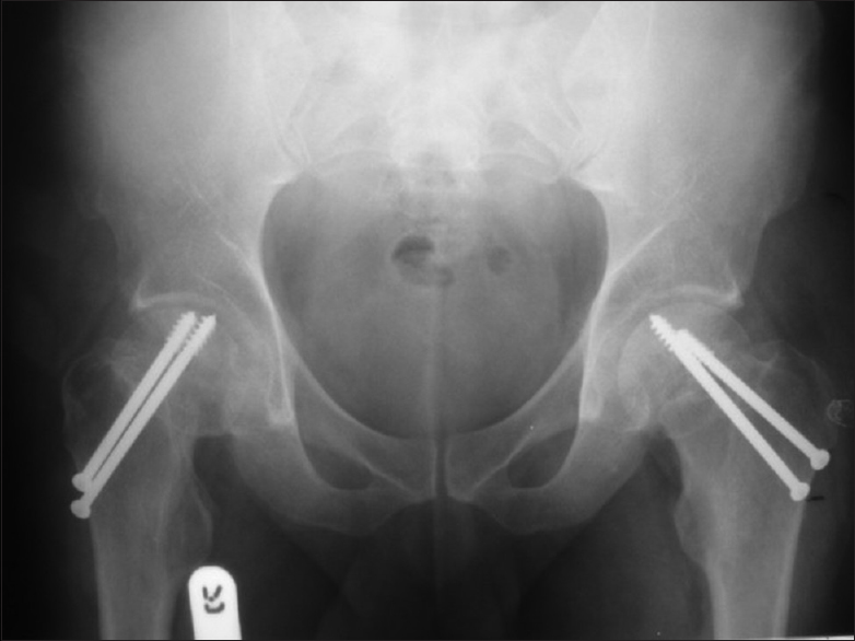 Figure 2: Postoperative X-ray at 16 weeks confirming union of fractures