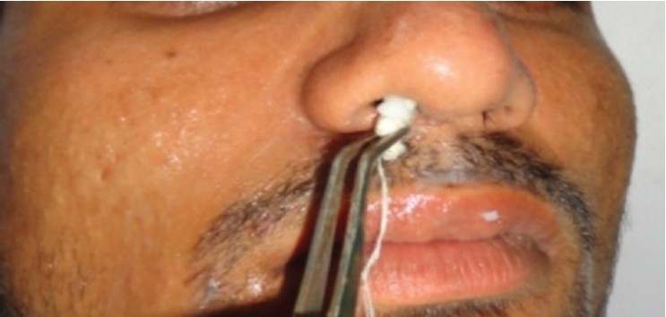 Figure 2: Nostril packed with gauze pack attached to the thread
