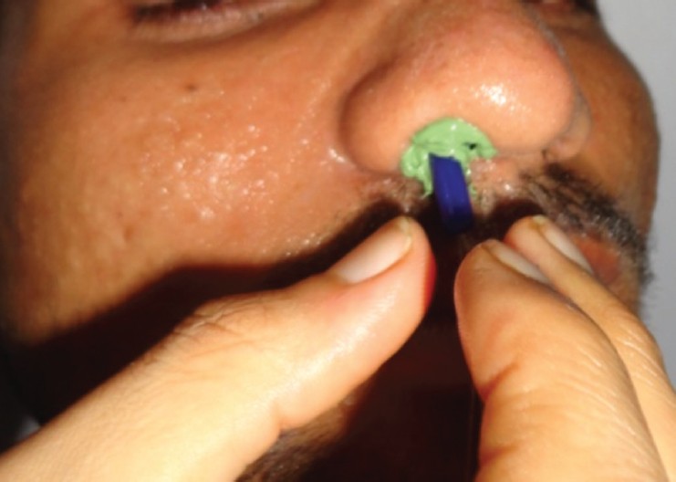 Figure 3: Ear plug loaded with impression material inserted into the nostril