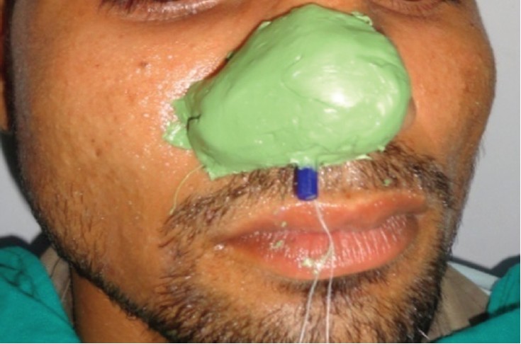 Figure 4: Completed impression with extending stem of ear plug for impression retrieval