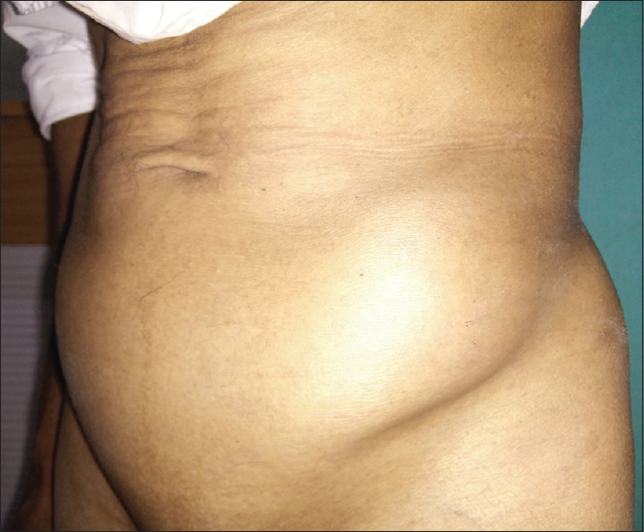 Figure 1: Patient presenting with a swelling over the abdominal wall