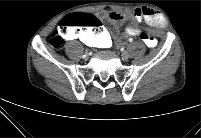 Figure 2: Computed tomography image showing the herniation of bowel