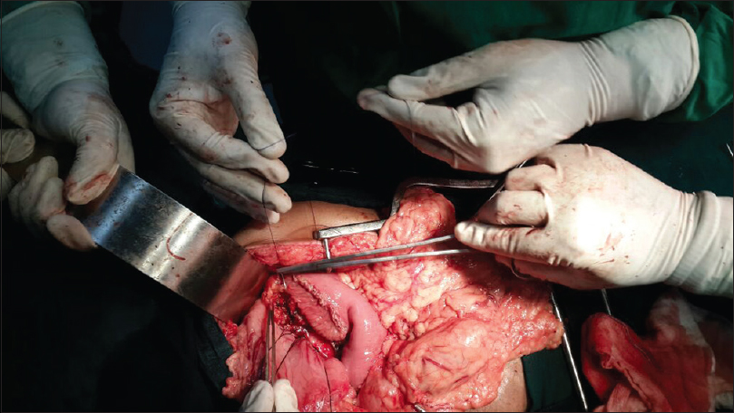Figure 3: Dissection of the contents of the hernial swelling