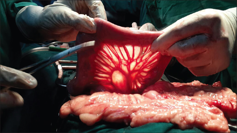 Figure 4: Unharmed bowel as content of the hernia