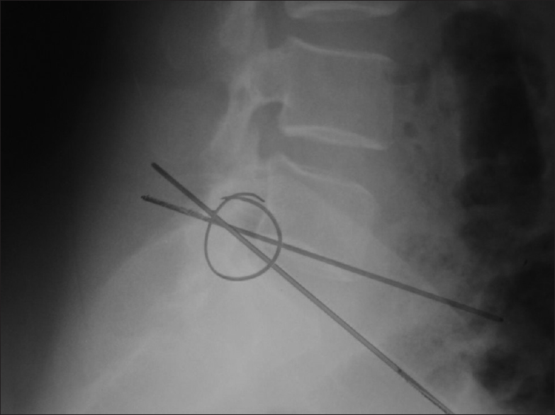 Figure 10: Intersection of the measurement lines within the intervertebral foramen