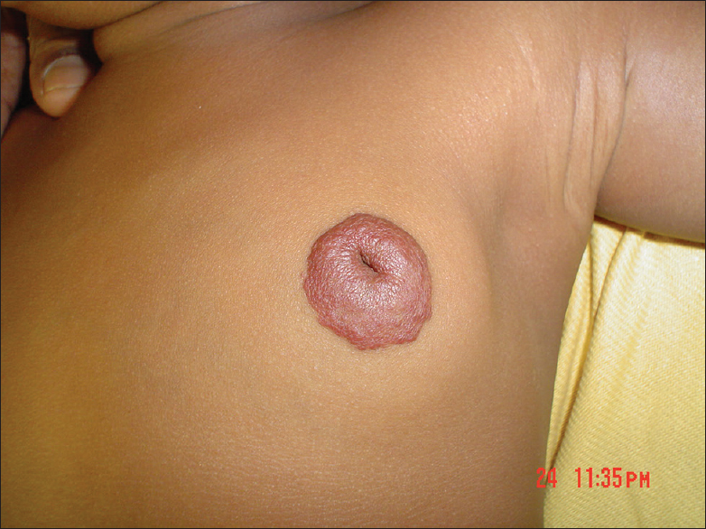 Figure 1: Circumferentially enlarged areola on the left breast with a diameter of 4 cm