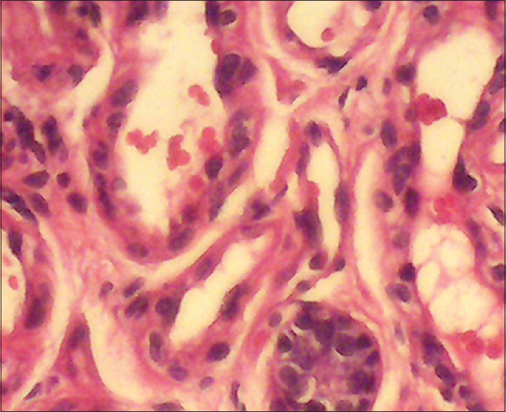 Figure 3: Haemangioma of the breast showing several blood vessels and a duct of the breast at the bottom right-hand corner (H and E, ×40)