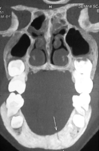 Figure 1: Coronal facial computed tomography depicting fractured mandible symphysis (arrows)