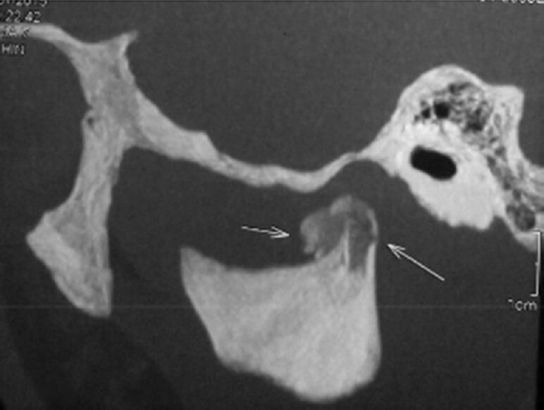 Figure 2: Sagittal facial computed tomography depicting fractured medial pole of the right condylar head